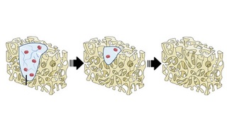 Hydrogel_kosti_00.jpg